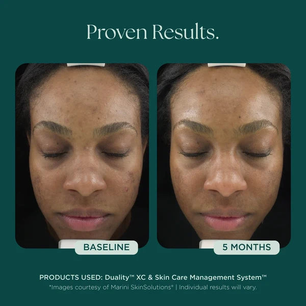 Marini SkinSolutions Duality XC Acne Treatment