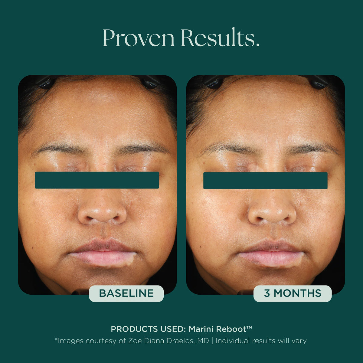Marini SkinSolutions Reboot® PDRN Face Serum