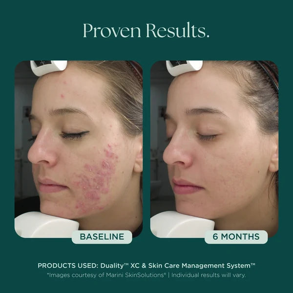 Marini SkinSolutions Duality XC Acne Treatment