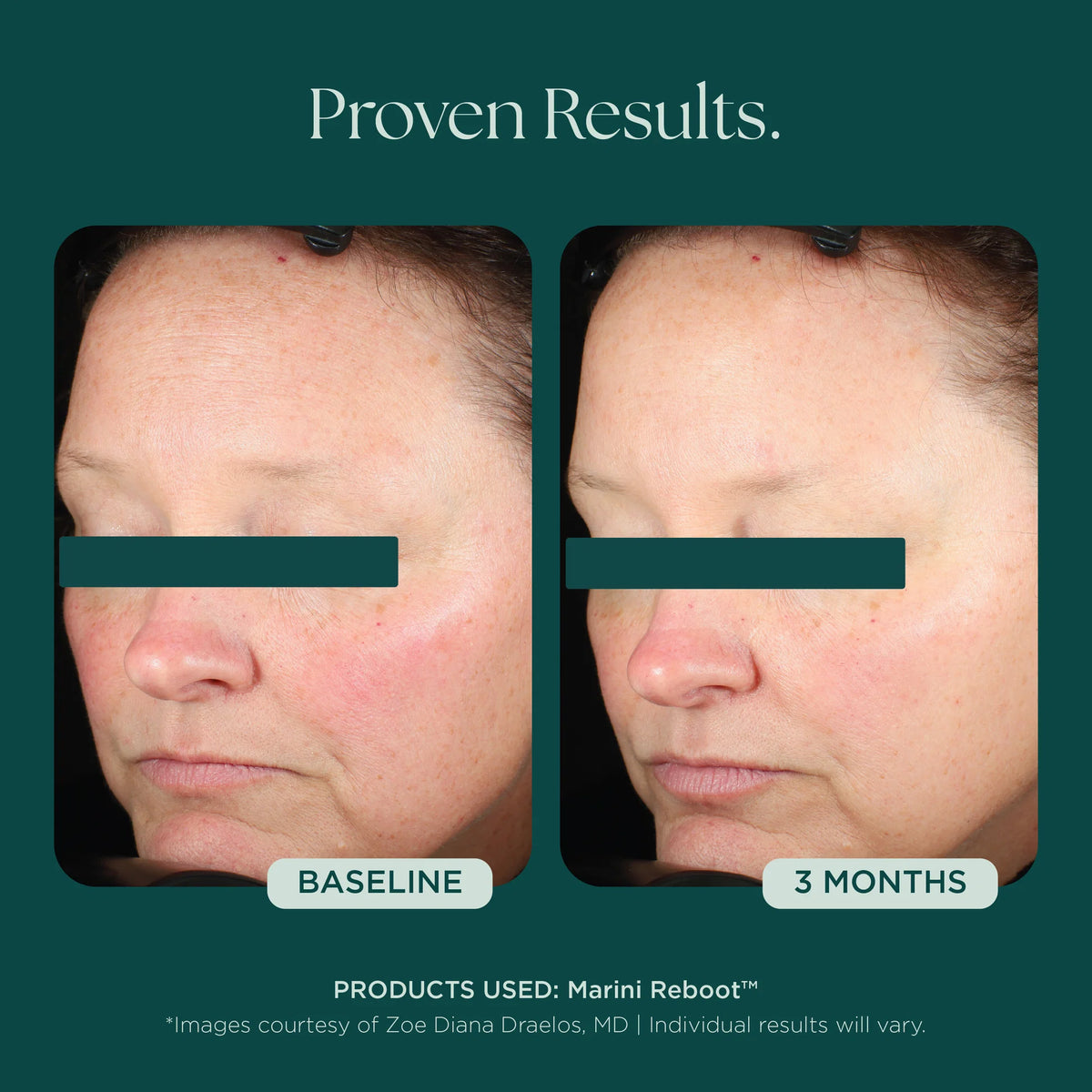 Marini SkinSolutions Reboot® PDRN Face Serum